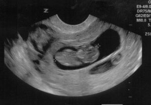 twin ultrasound (2)